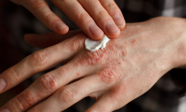 image: Psoriasis: lokalbehandling